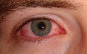 Conjunctivitis affection