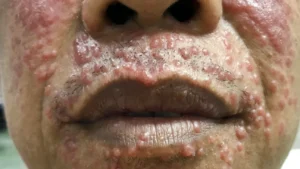 Molluscum contagiosum