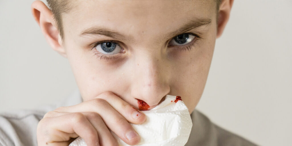 Nose Bleeding